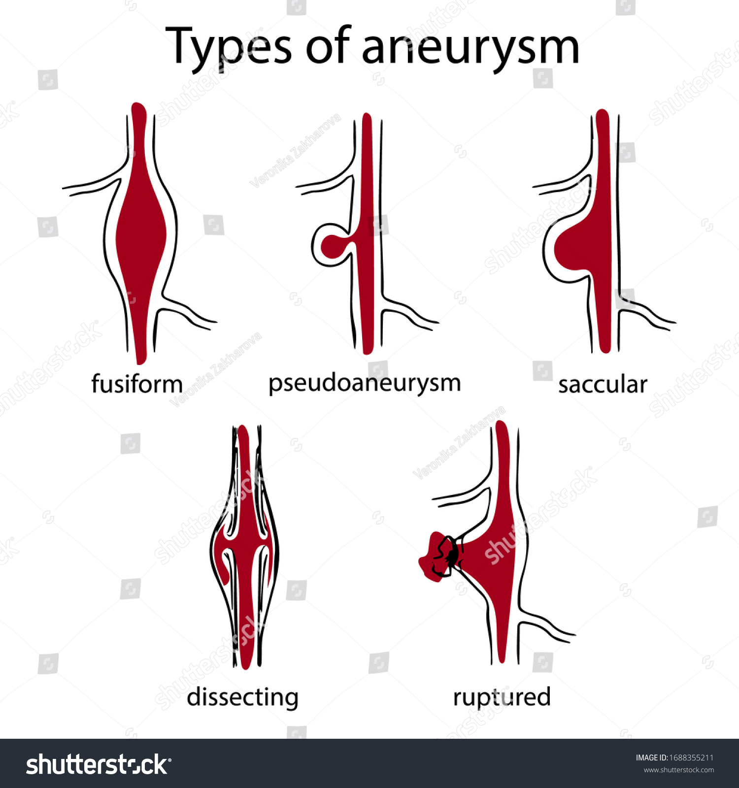 Types of aneurysm. Fusiform, pseudoaneurysm, - Royalty Free Stock ...