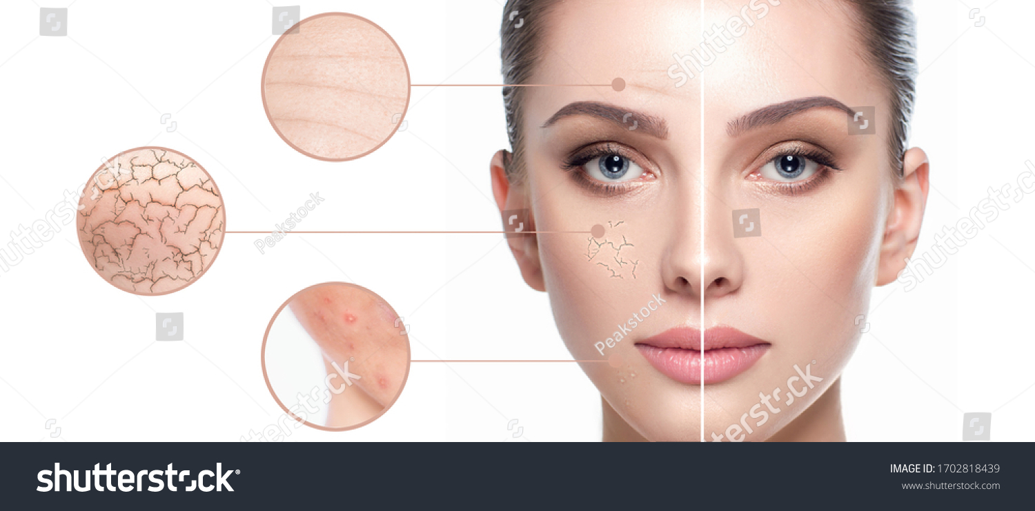 Female face close-up, showing skin problems. Dry skin, acne, wrinkles and other imperfections. Rejuvenation, hydration and skin treatment #1702818439