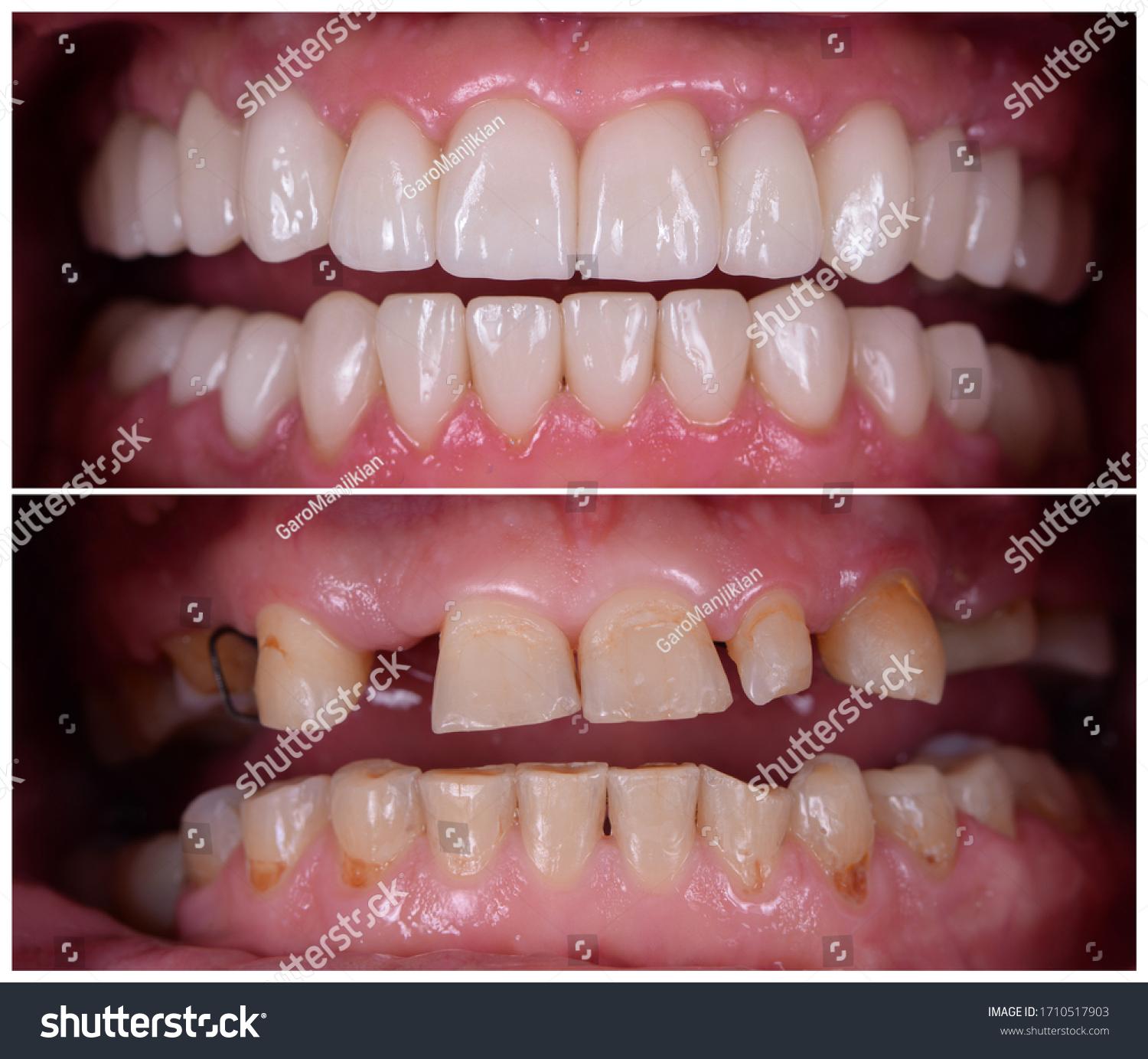 full mout recovery by press ceramic crowns and implants #1710517903
