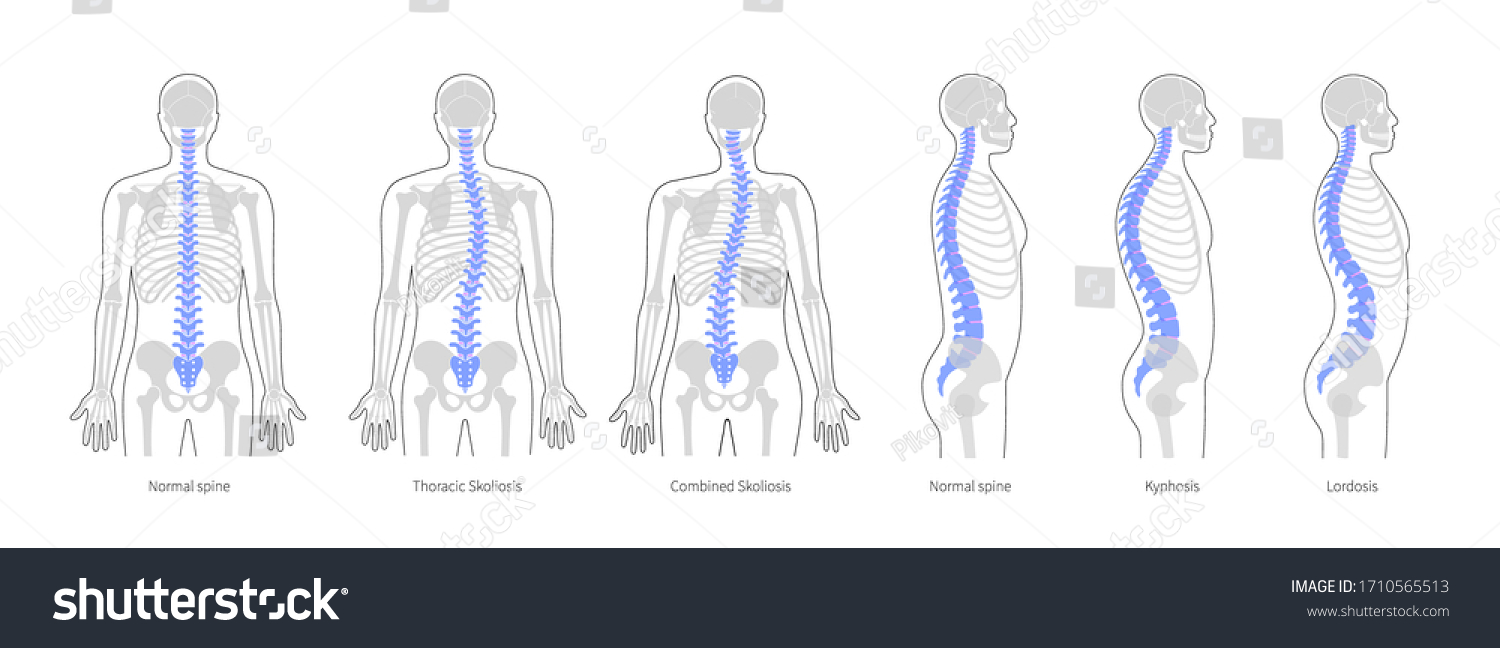 Spinal deformity flat vector illustration. Kyphosis, lordosis and scoliosis of spine infographics.. Body posture defect. Medical, educational and science banner
 #1710565513