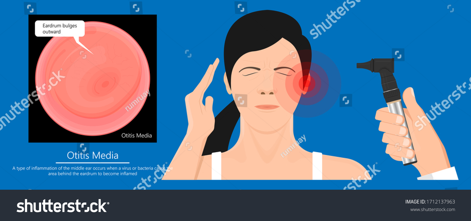 Acute Otitis Media Air Filled Space Eardrum Royalty Free Stock Vector 1712137963 