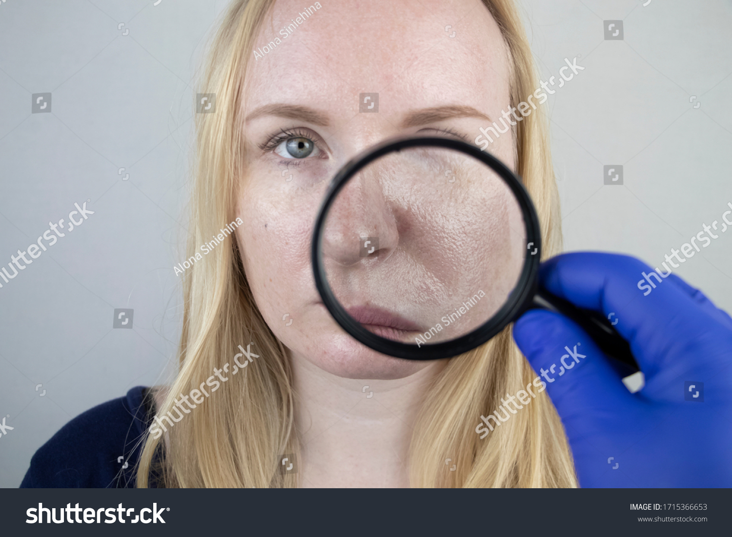 Oily and problem skin. Portrait of a blonde girl with acne, oily skin and pigmentation #1715366653