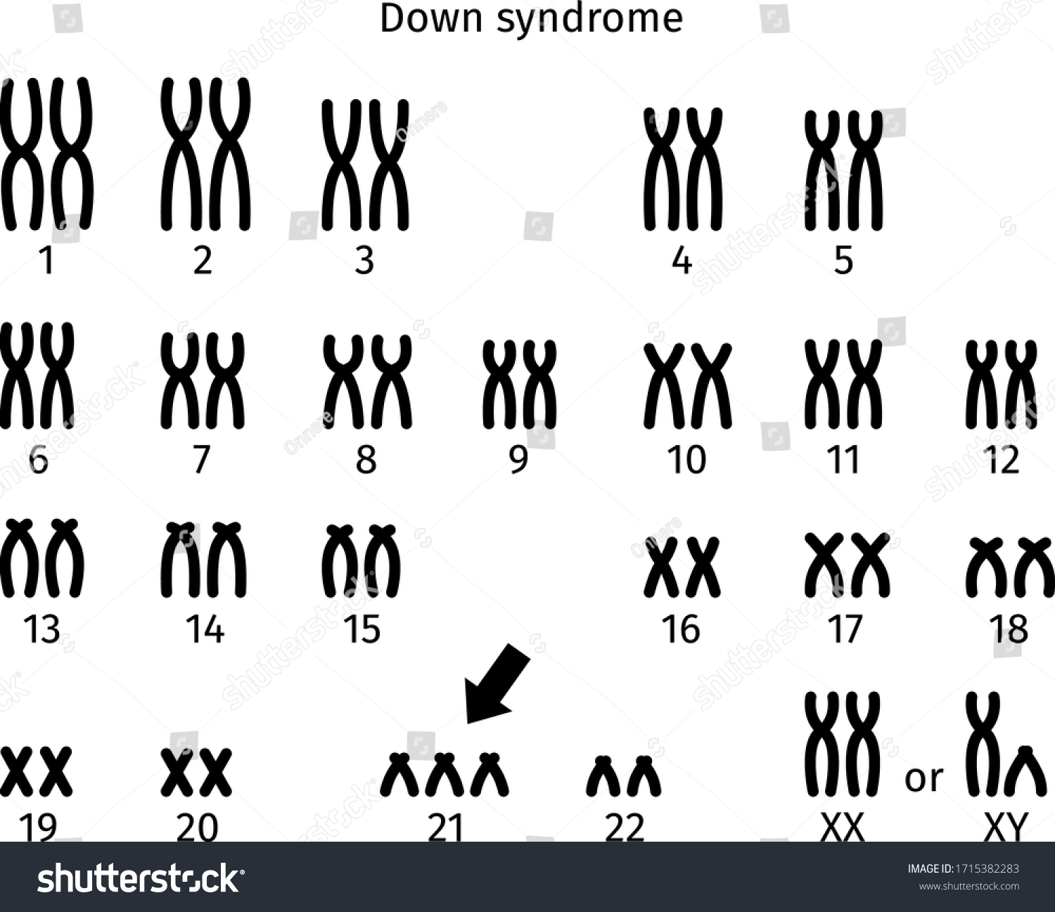Scheme Of Down Syndrome Karyotype Of Human Royalty Free Stock Vector 1715382283 8827