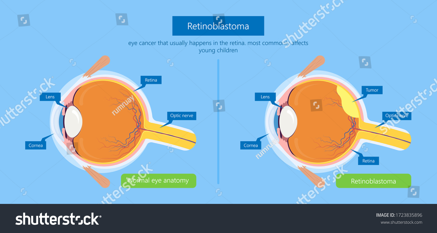 Retinoblastoma blind ophthalmologist Royalty Free Stock Vector