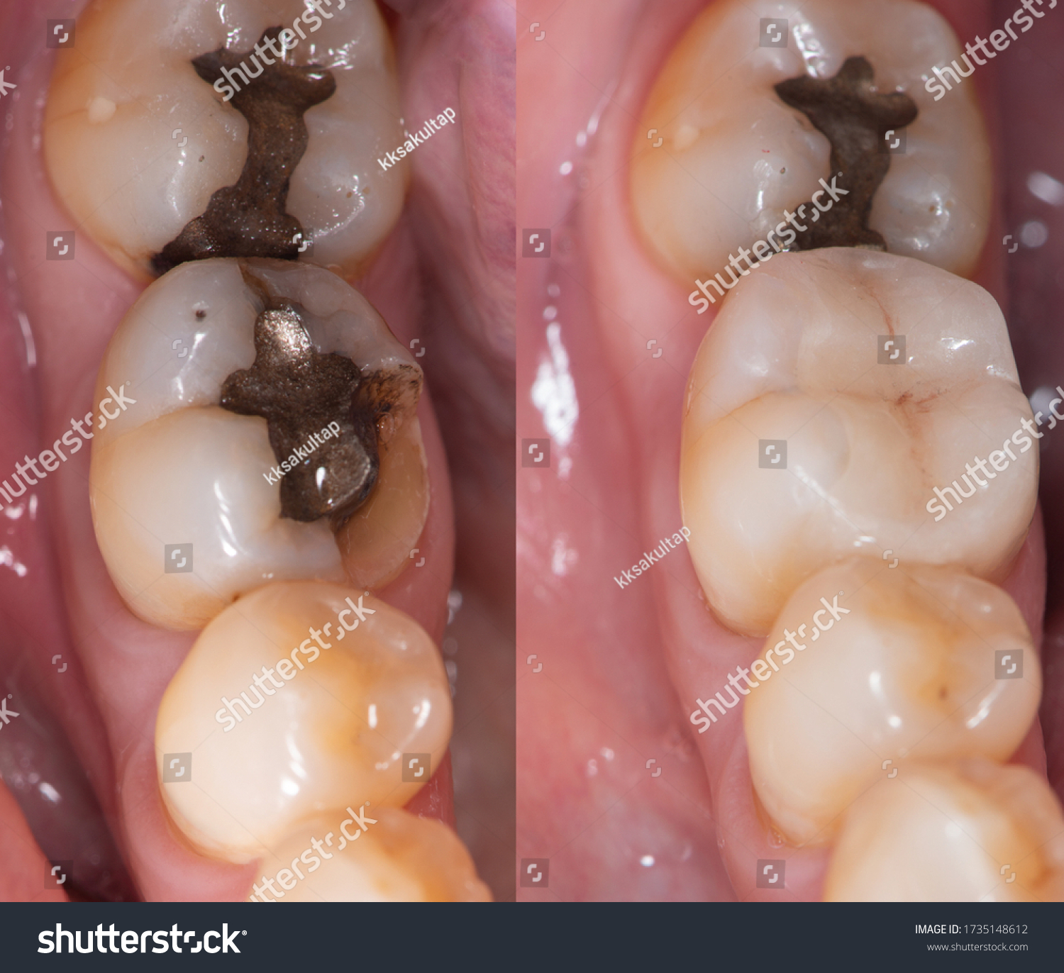 Dental collage, closeup of teeth before and after dental ceramic onlay treatment. #1735148612