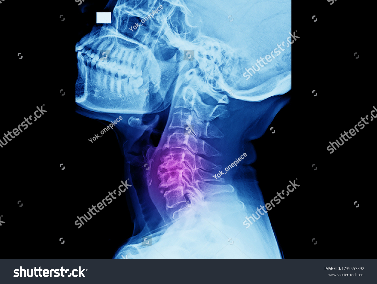 Lateral projection x-ray of cervical spine showing cervical spondylosis at multiple levels. This disease causes neck pain, radioculopathy and myelopathy.  #1739553392