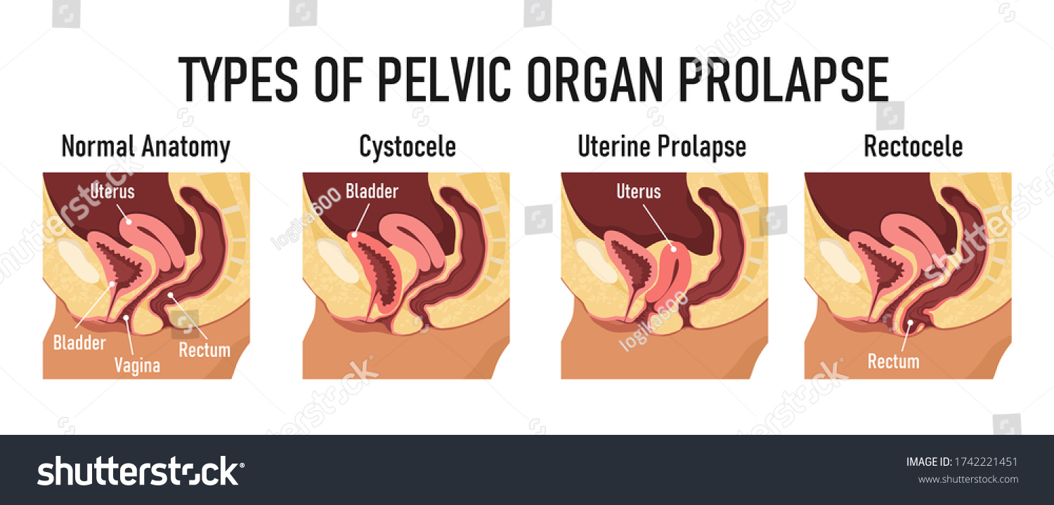 Types Of Pelvic Organ Prolapse Cystocele Royalty Free Stock Vector