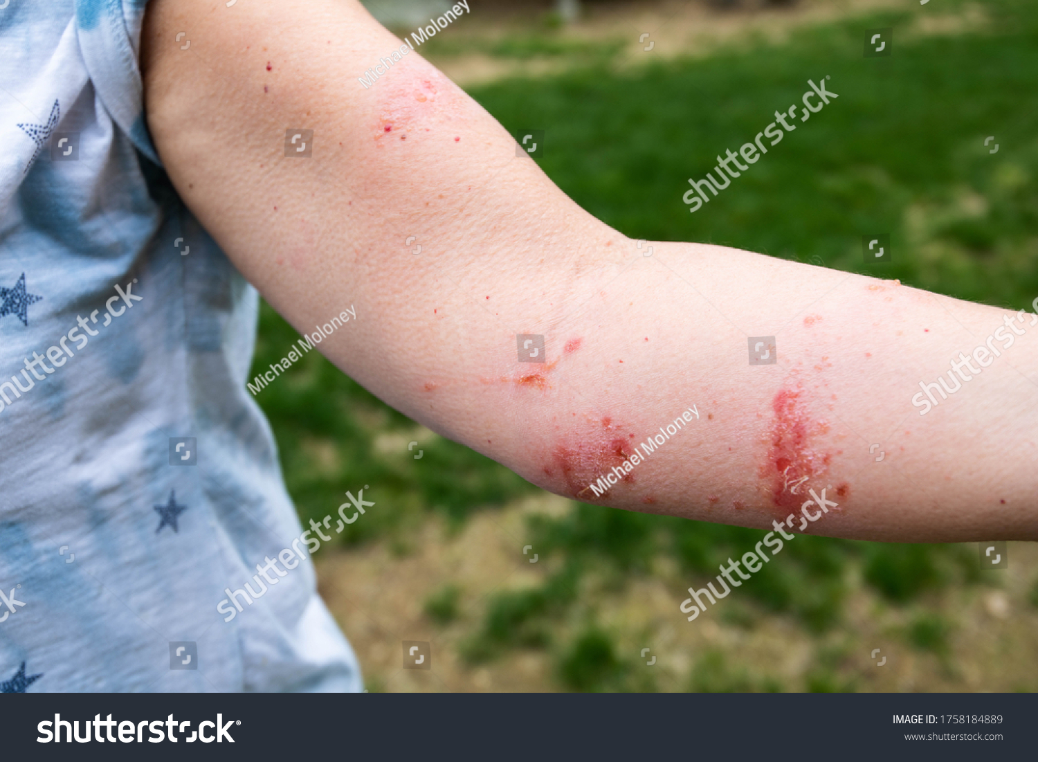 Severe poison ivy/poison oak rash and reaction - Royalty Free Stock ...