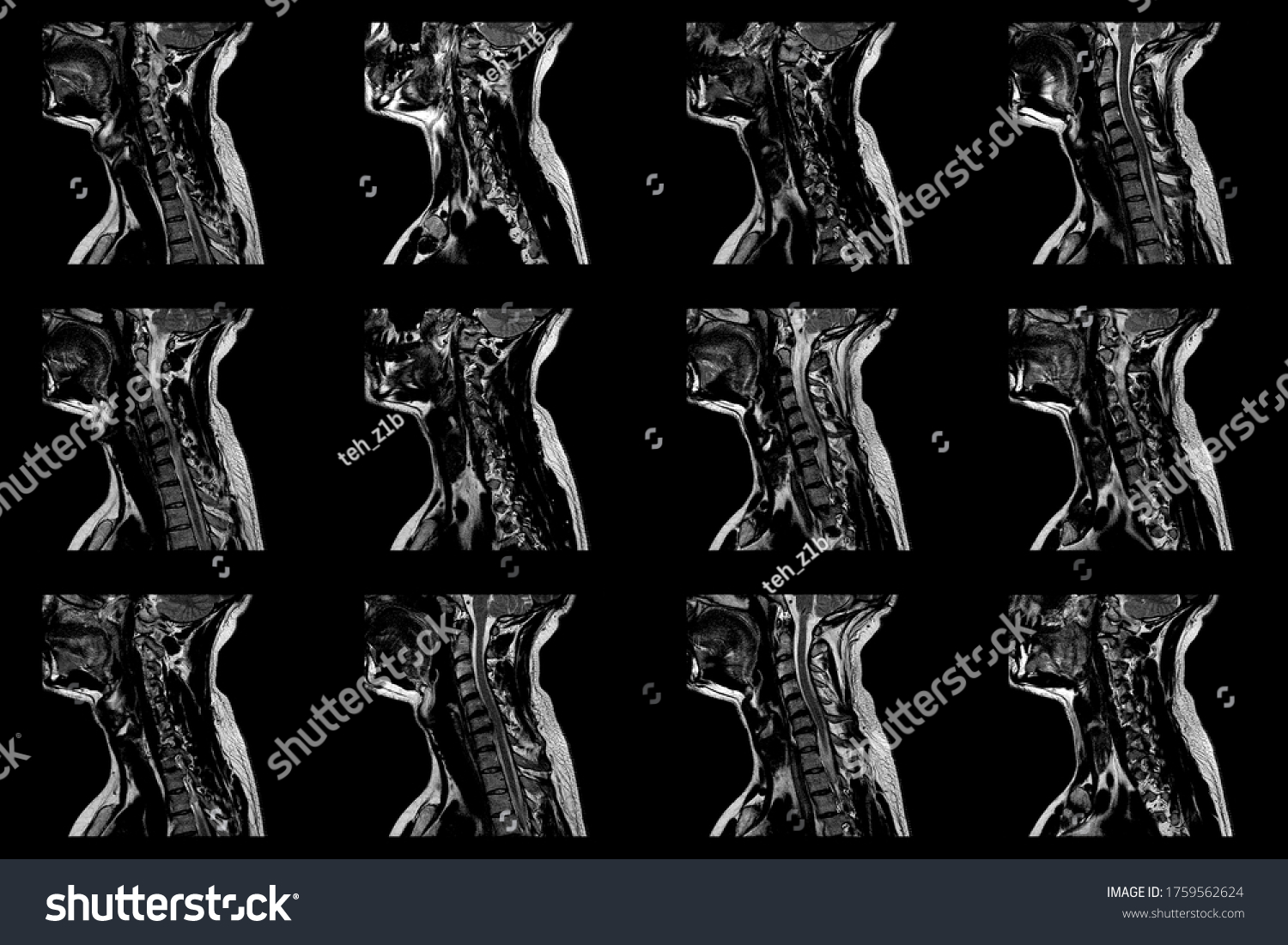 Set Of Sagittal MRI Scans Of Neck Area Of - Royalty Free Stock Photo ...