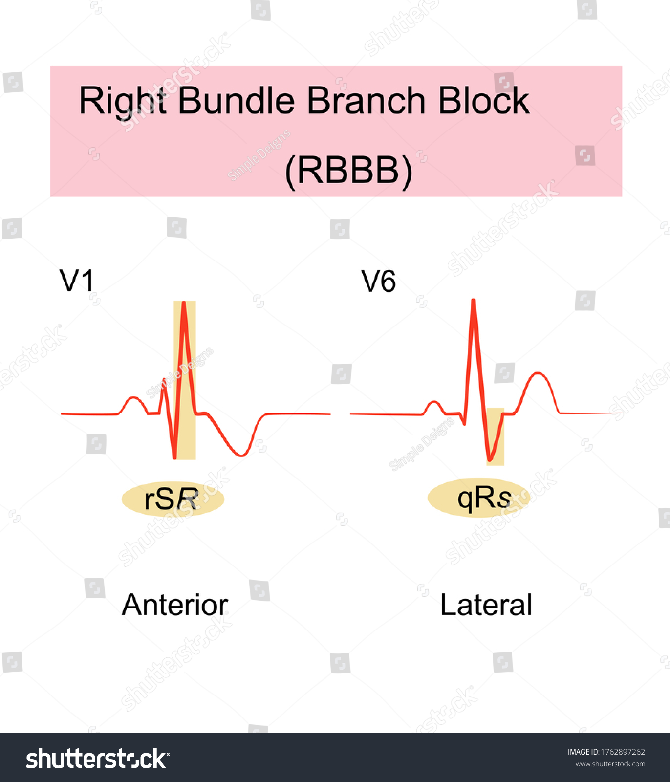 Right Bundle Branch Block(RBBB) Of ECG Is A - Royalty Free Stock Vector ...