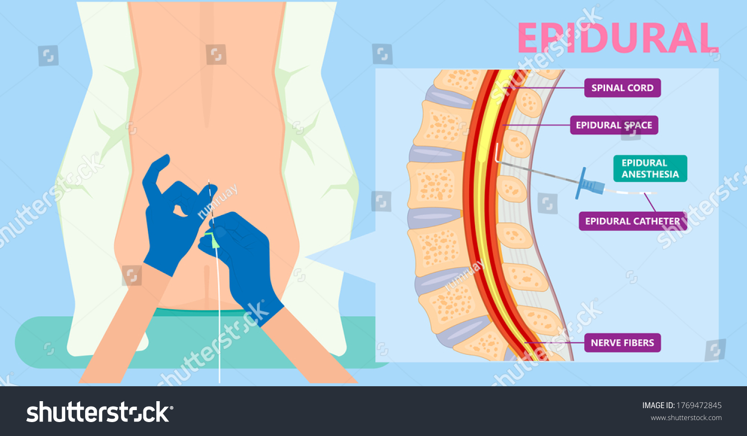 Epidural Spinal Block Anaesthesia Pinched - Royalty Free Stock Vector ...