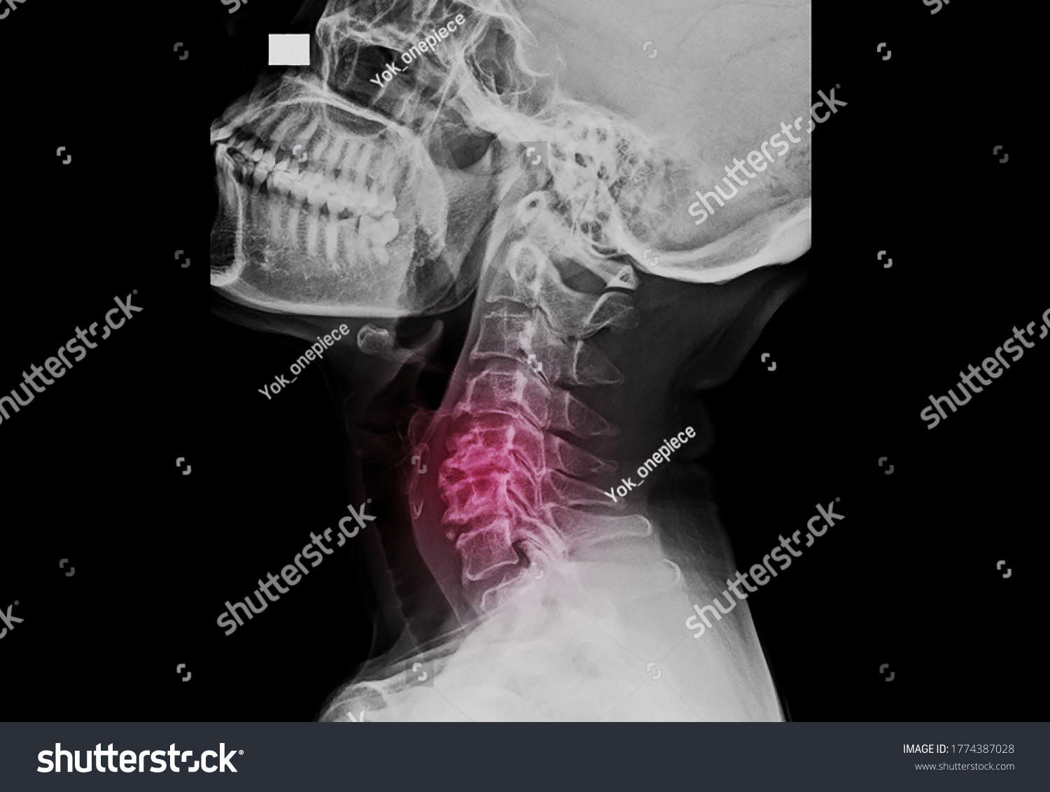 A lateral projection of cervical spine x-ray showing multiple degenerative spondylosis causing neck pain and myelopathy. The patient needs surgical decompression, reconstruction and spinal fusion. #1774387028