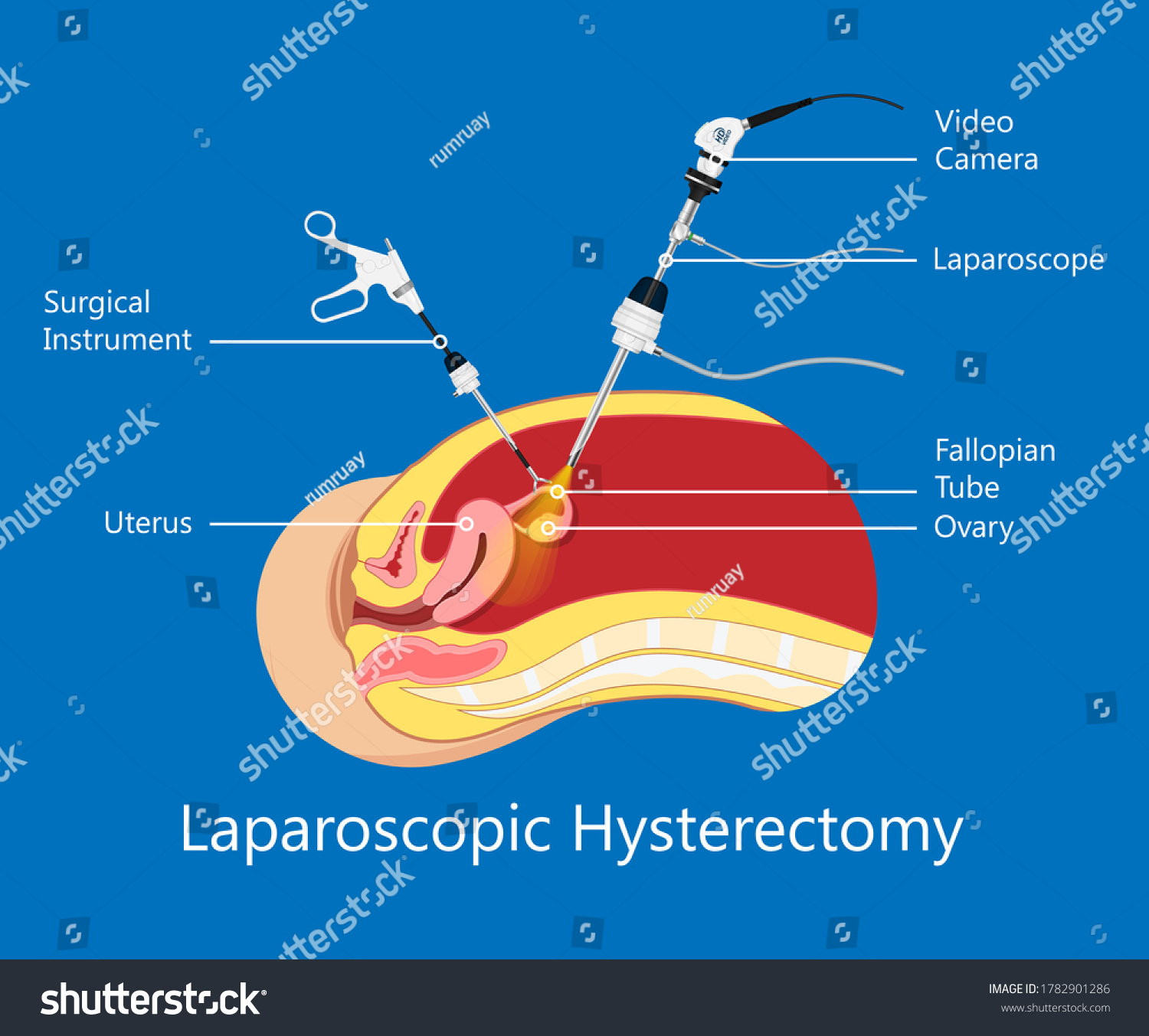 Laparoscopic Hysterectomy Medical Surgical Treat Royalty Free Stock Vector 1782901286 9888