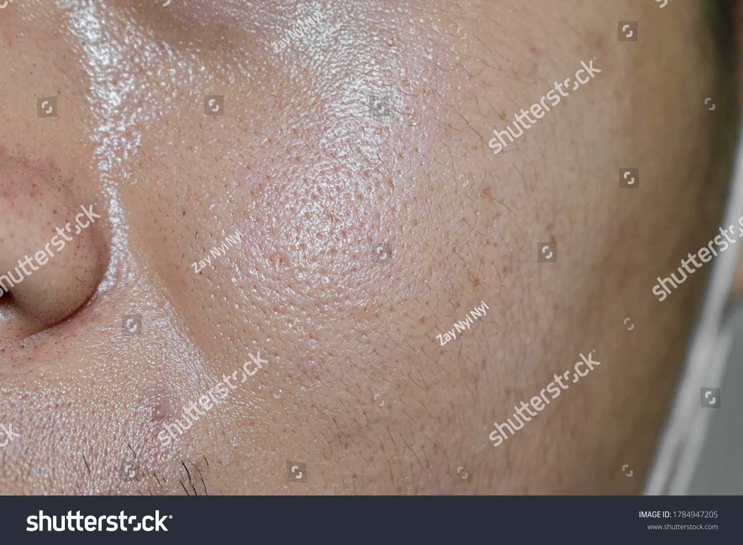 Oily and fair skin, wide pores of Southeast Asian, Myanmar or Korean adult young man. Oily skin is the result of the overproduction of sebum from sebaceous glands. #1784947205