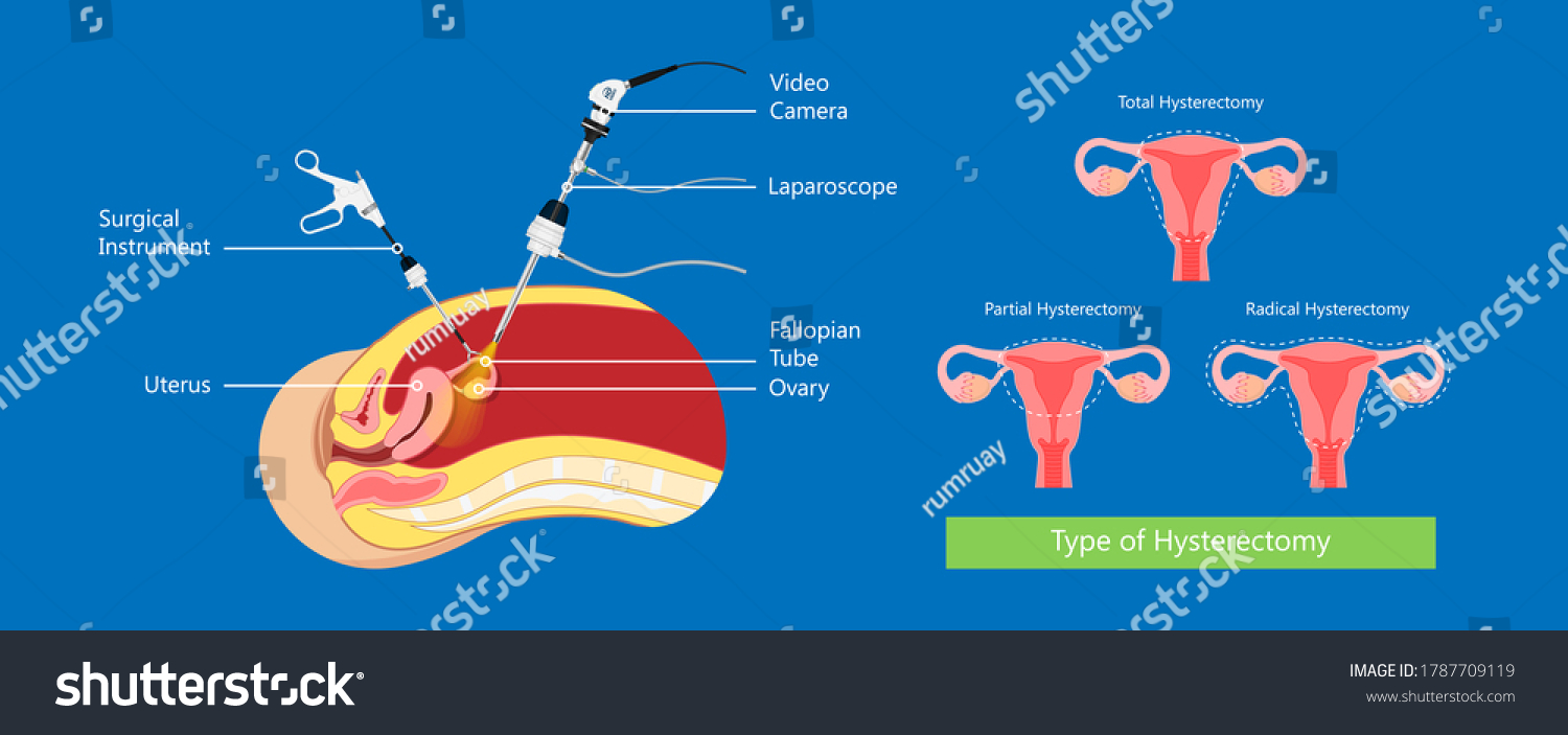 Laparoscopic Hysterectomy Medical Surgical Treat Royalty Free Stock Vector 1787709119 1458