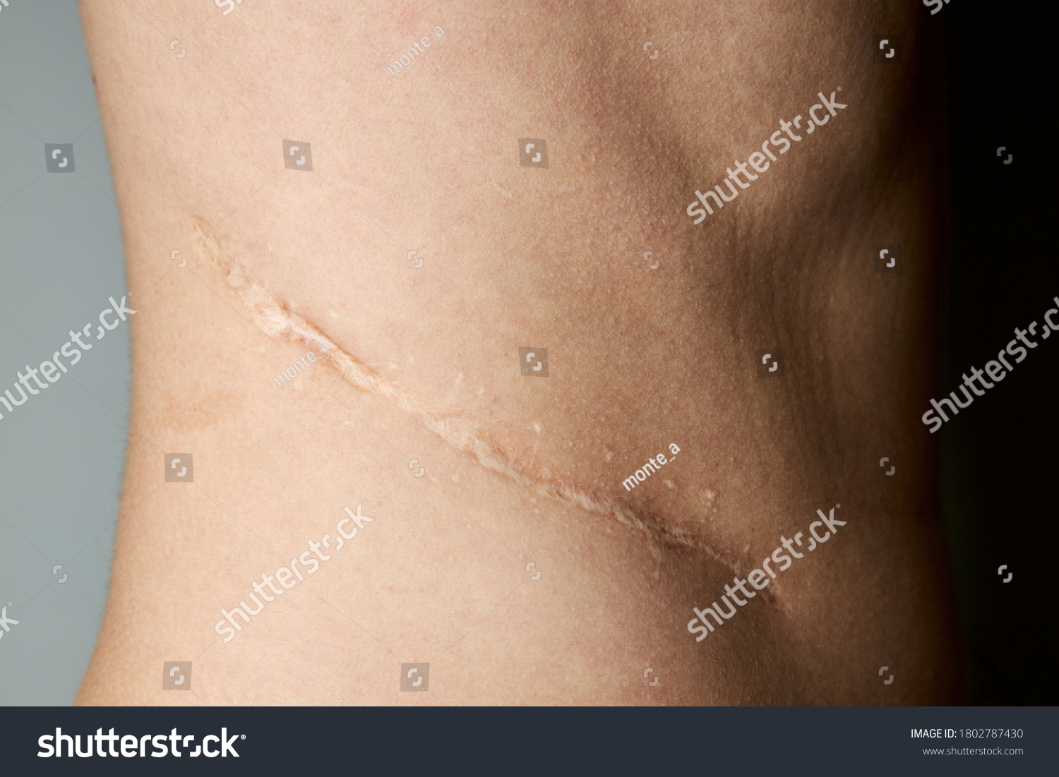 surgery scar after kidney pyelonephritis. after remove kidney operation. caucasian person close up over gray background. #1802787430
