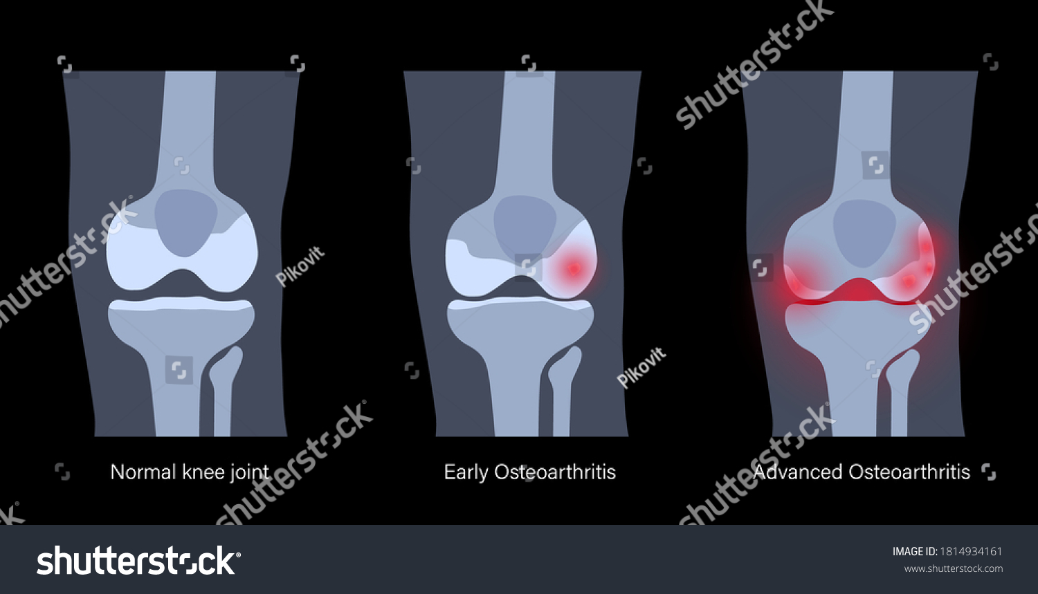 X ray with stages of osteoarthritis in knee - Royalty Free Stock Vector ...