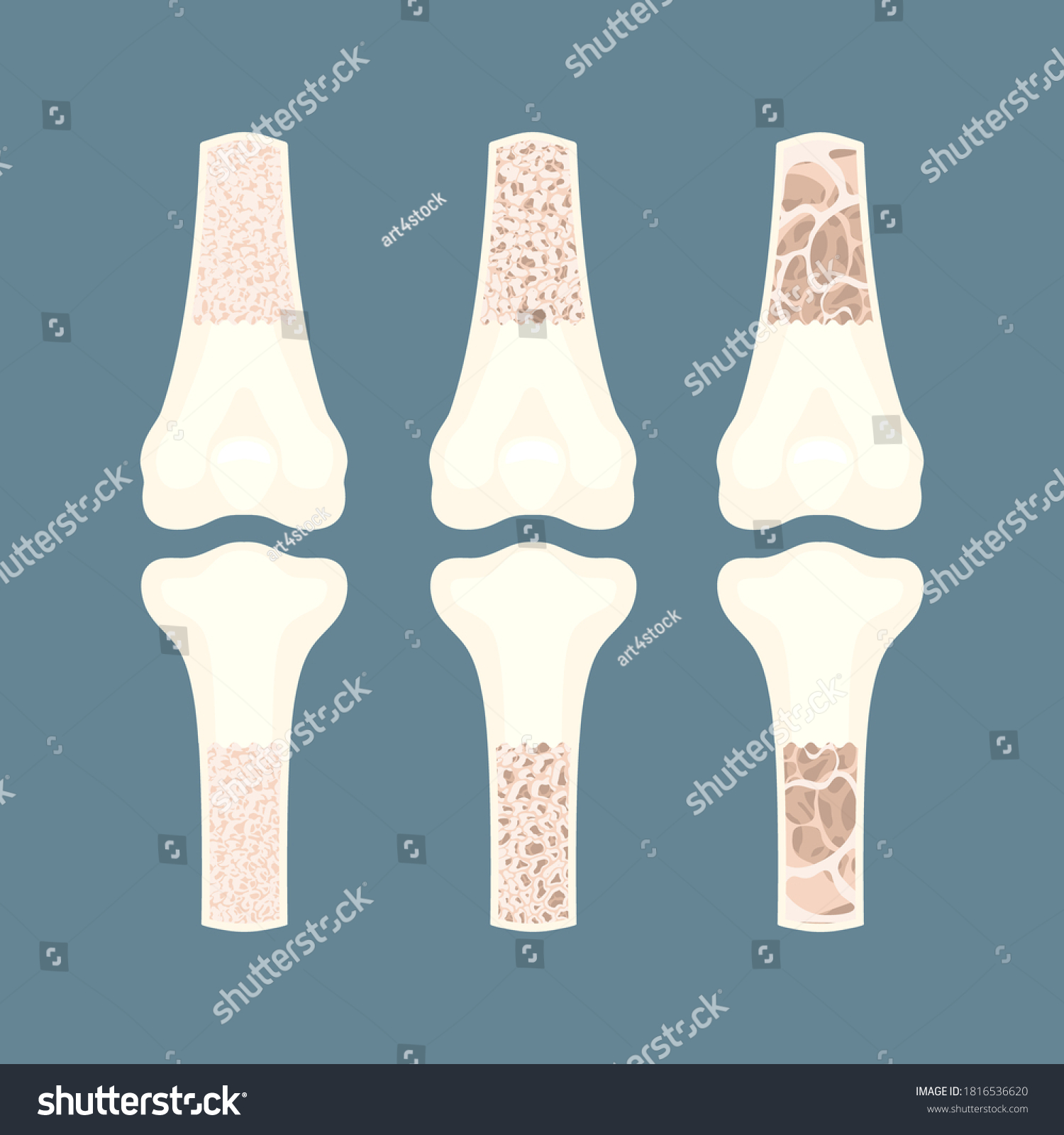 Osteoporosis Stages Shown In Bones Cross Section Royalty Free Stock Vector Avopix Com