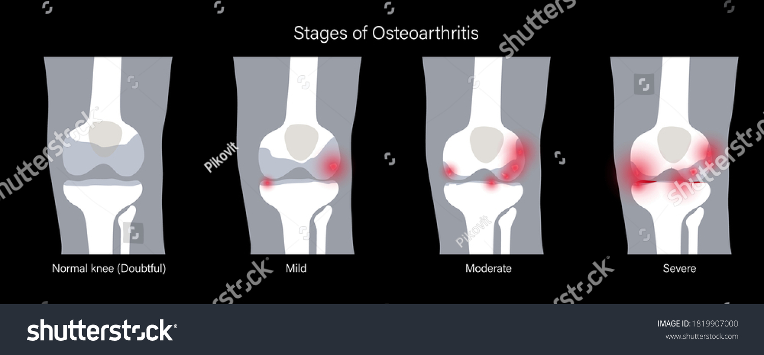 X ray with stages of osteoarthritis in knee - Royalty Free Stock Vector ...