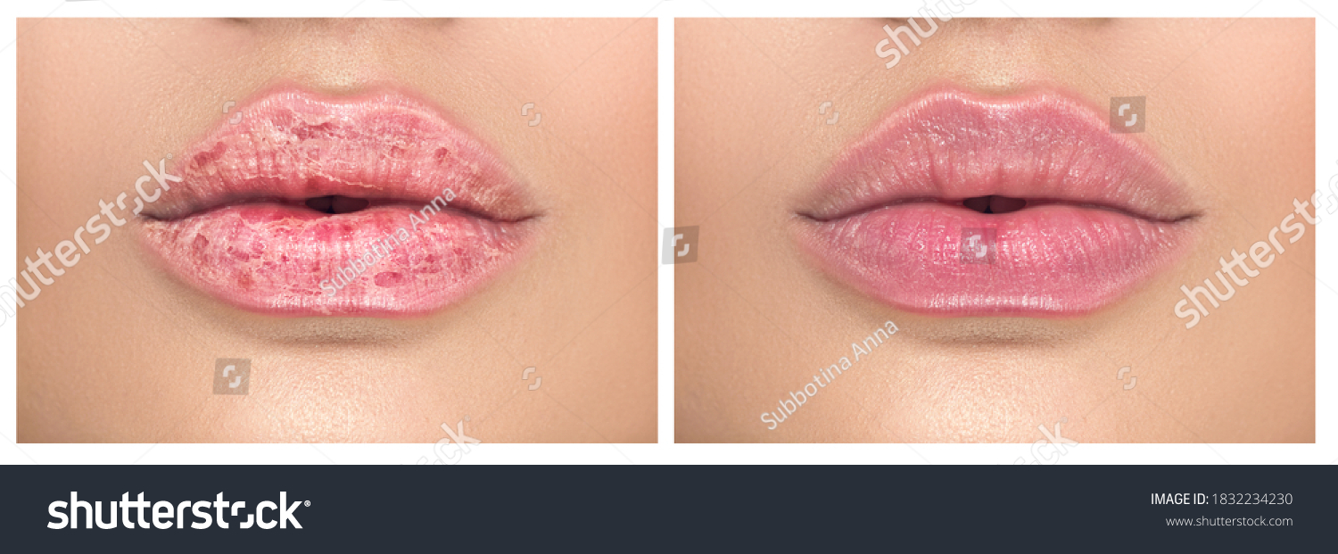Lips. Close up of chapped, cracked lips, dry skin problem with mouth disease before and after treatment. Healthy woman lips, macro shot.  #1832234230