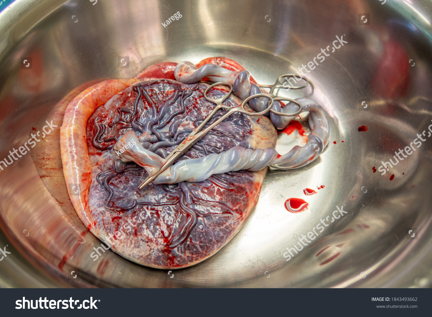 a placenta with umbilical cord is in a silver saline bowl after a birth #1843493662