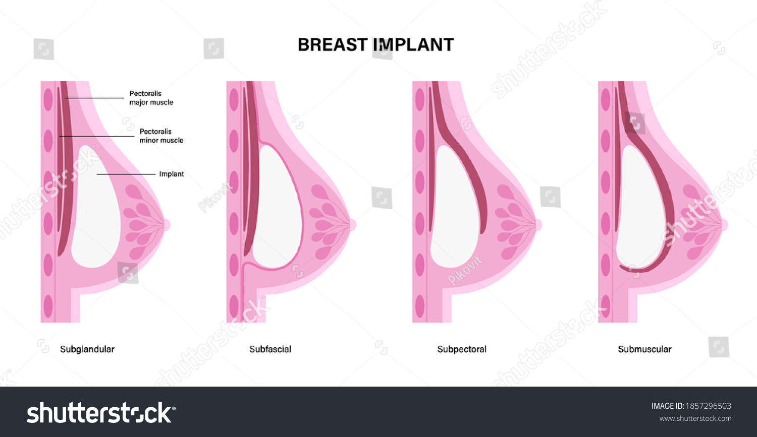 Breast Implant Types In Female Silhouette Royalty Free Stock Vector 1857296503 7602