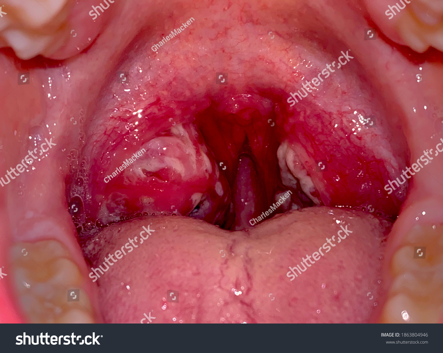 Severe Streptococcal Pharyngitis shown in a white adult male. #1863804946