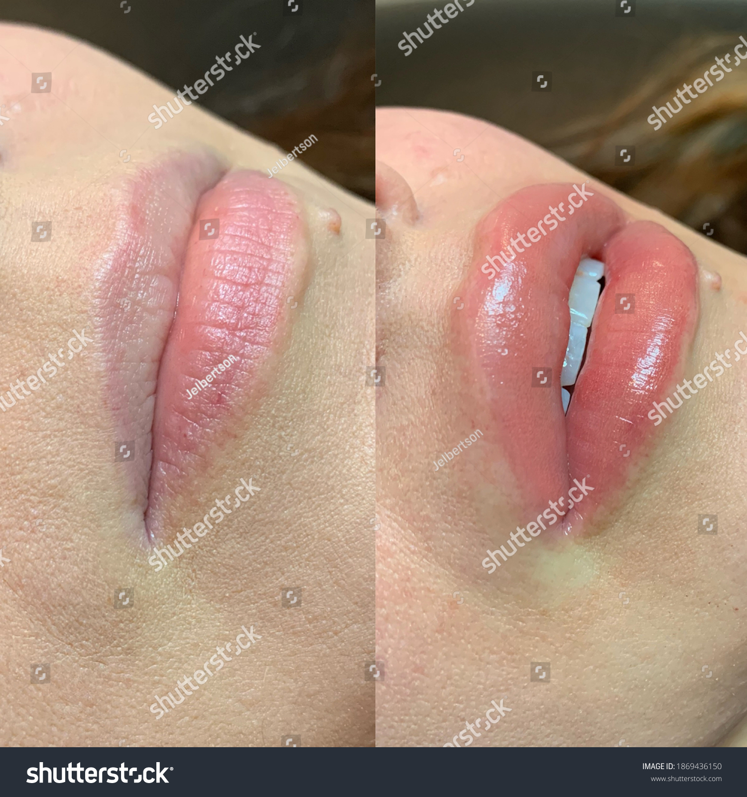 Lip blush tattoo treatment before and after #1869436150