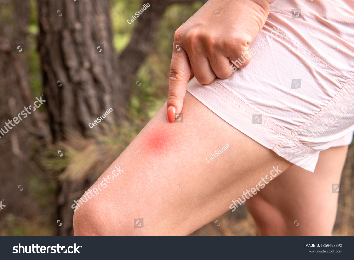 woman shows her finger at an insect bite. The leg with red spot caused by insect bite on leg skin. Insect Bite. concept of protection from insect bites #1869493390