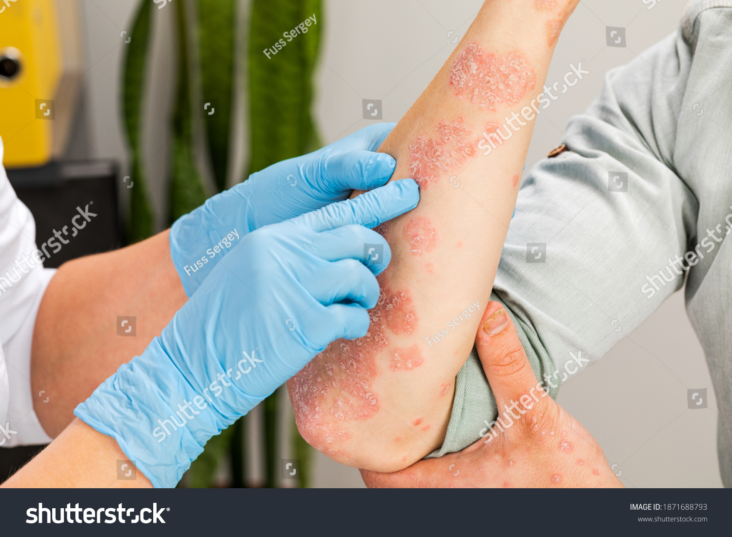 A dermatologist wearing gloves examines the skin of a sick patient. Examination and diagnosis of skin diseases-allergies, psoriasis, eczema, dermatitis. #1871688793