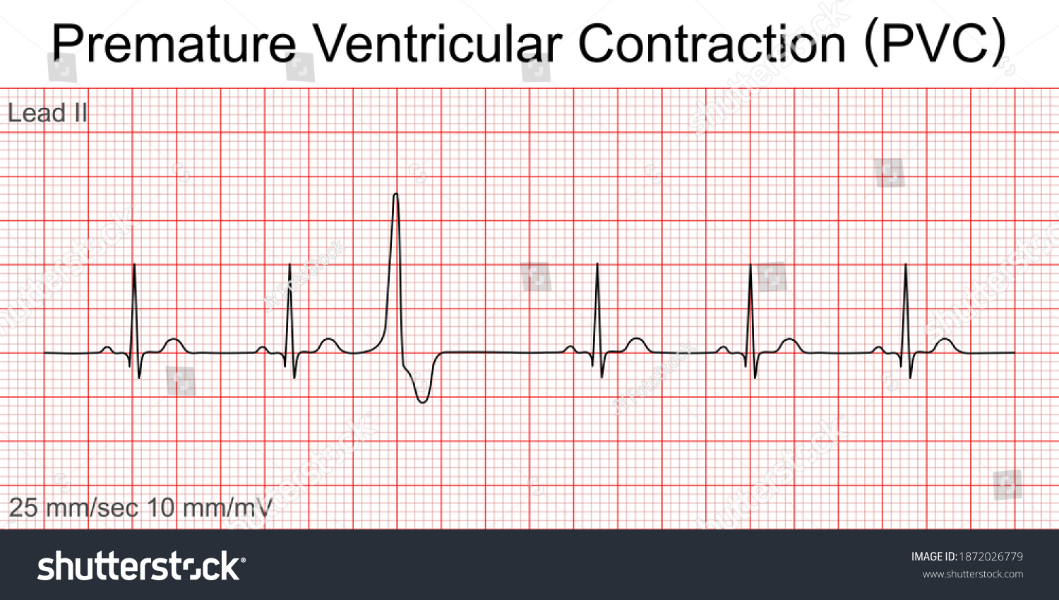 Electrocardiogram show Premature Ventricular Contraction (PVC) pattern ,Heart beat ,ECG ,EKG interpretation ,Vital sign ,Life line ,Medical healthcare symbol. #1872026779