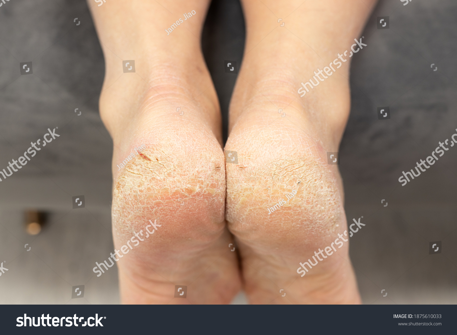 Corn callus cracks on sole heel foot close up. Dry skin dermatology problem. bloody cracks, common skin disease in dry winter, dehydrated skin on the heels of male feet with calluses #1875610033