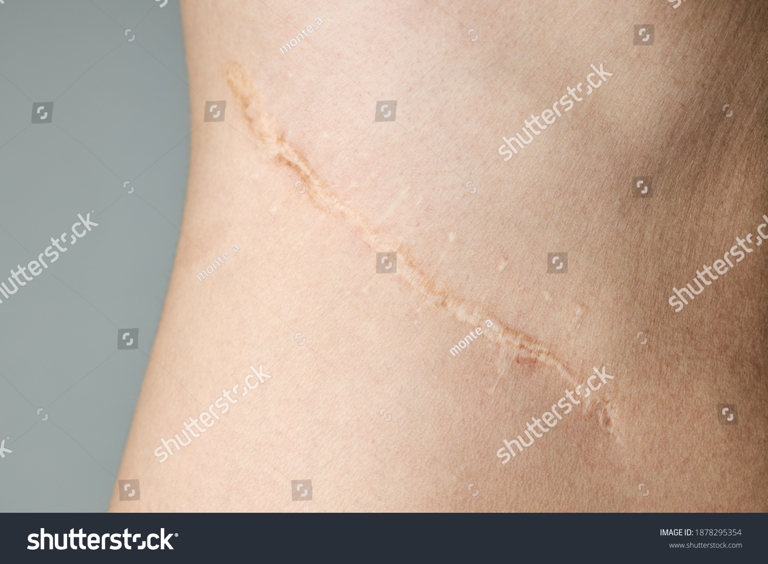 surgery scar after kidney pyelonephritis.  #1878295354