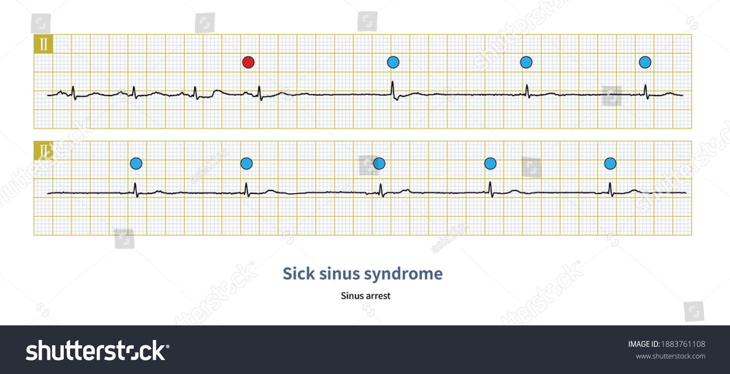 In sick sinus syndrome, sinus arrest can lead to - Royalty Free Stock ...