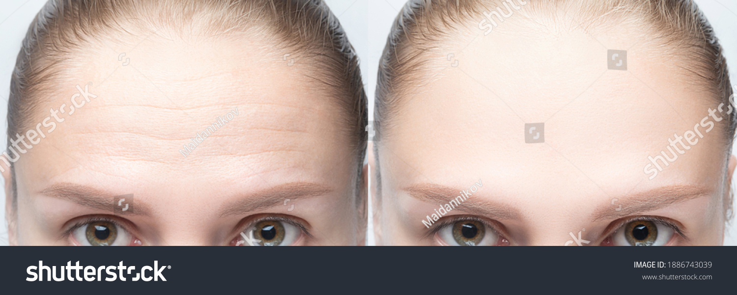Forehead wrinkles before and after injection, treatment, surgery. Womans face close up. #1886743039