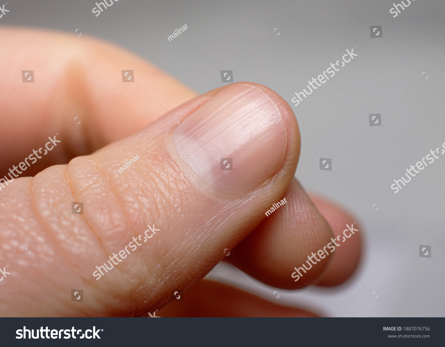 Ridged fingernail of a thumb finger of a caucasian woman with vertical ridges. Very short cut nails. #1887076756