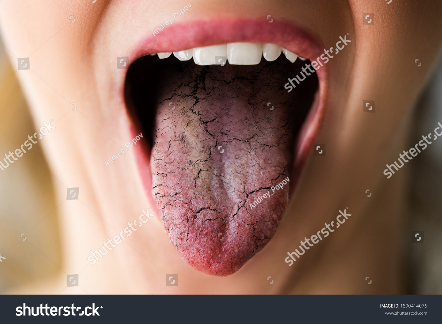 Woman Tongue With Bad Bacteria Candidiasis And Pain #1890414076