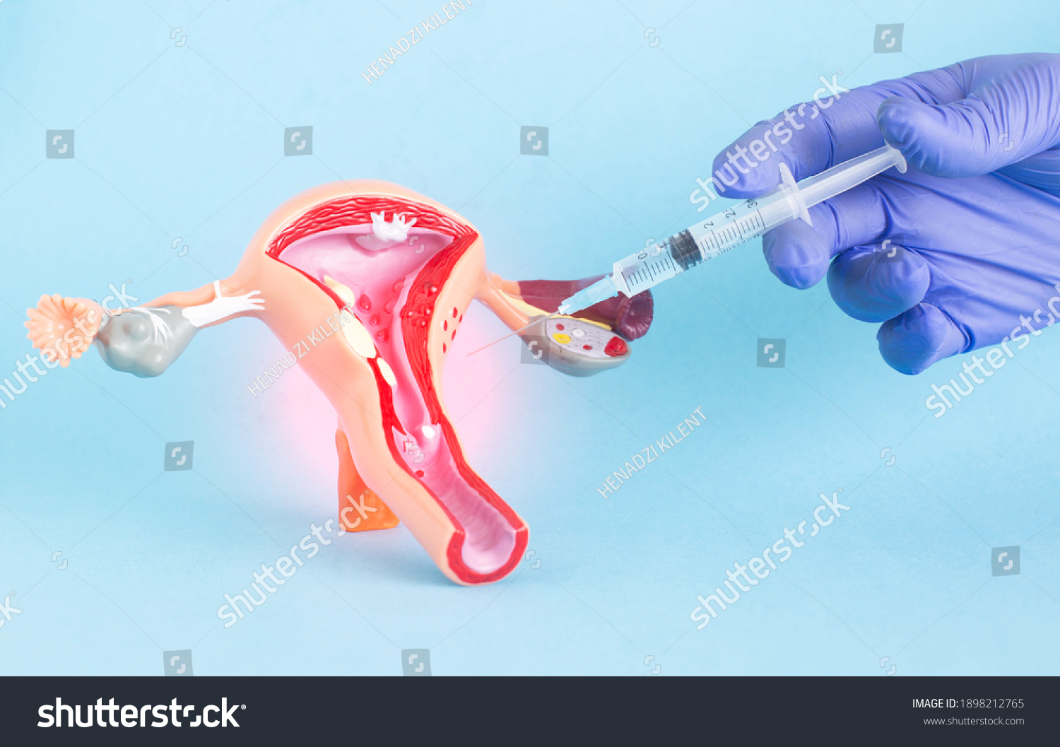 Doctor plastic surgeon with a syringe on the background of a model of female genital organs. The concept of intimate plastic surgery for a girl, aesthetic #1898212765