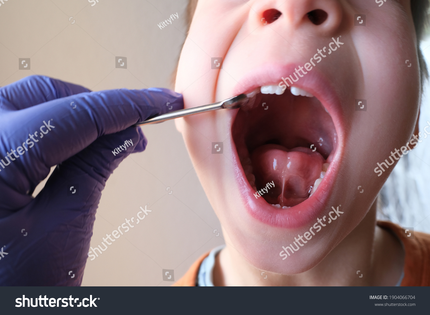 dentist, doctor examines oral cavity of small patient, length of frenum, boy, kid performs articulation exercises for mouth, concept of speech disorders, correction, selective focus on bridle of tongu #1904066704