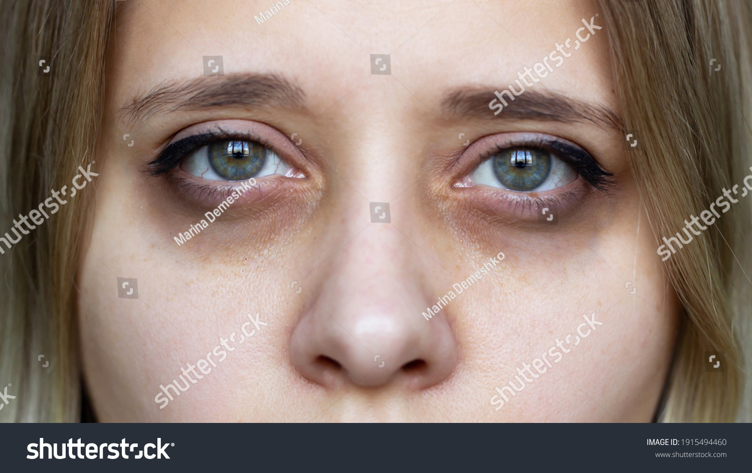 Cropped shot of a young female face. Green eyes with dark circles under the eyes and with red capillaries. Bruises under the eyes are caused by insomnia, fatigue, nervousness, lack of sleep and stress #1915494460
