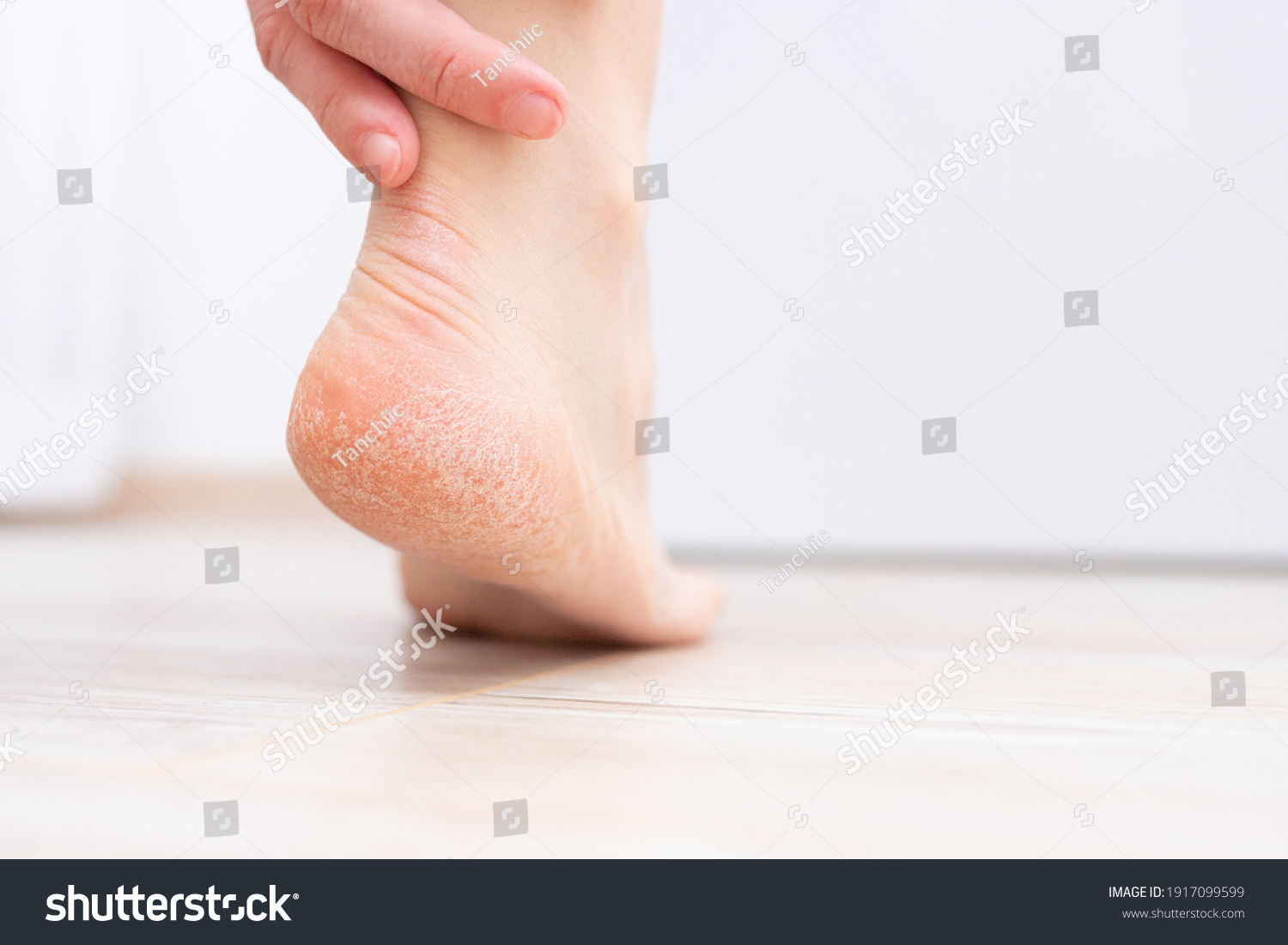 The dry skin on the heel is cracked. Treatment concept with moisturizing creams and exfoliation for healing wounds and pain when walking. Dehydrated skin on the heels of female feet #1917099599