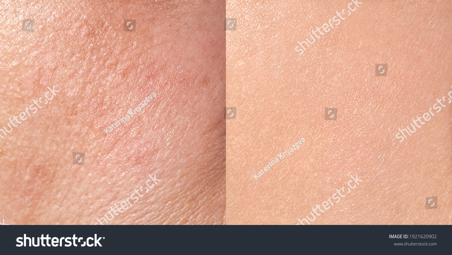 Skin before and after treatment, close-up, square format, horizontal #1921620902