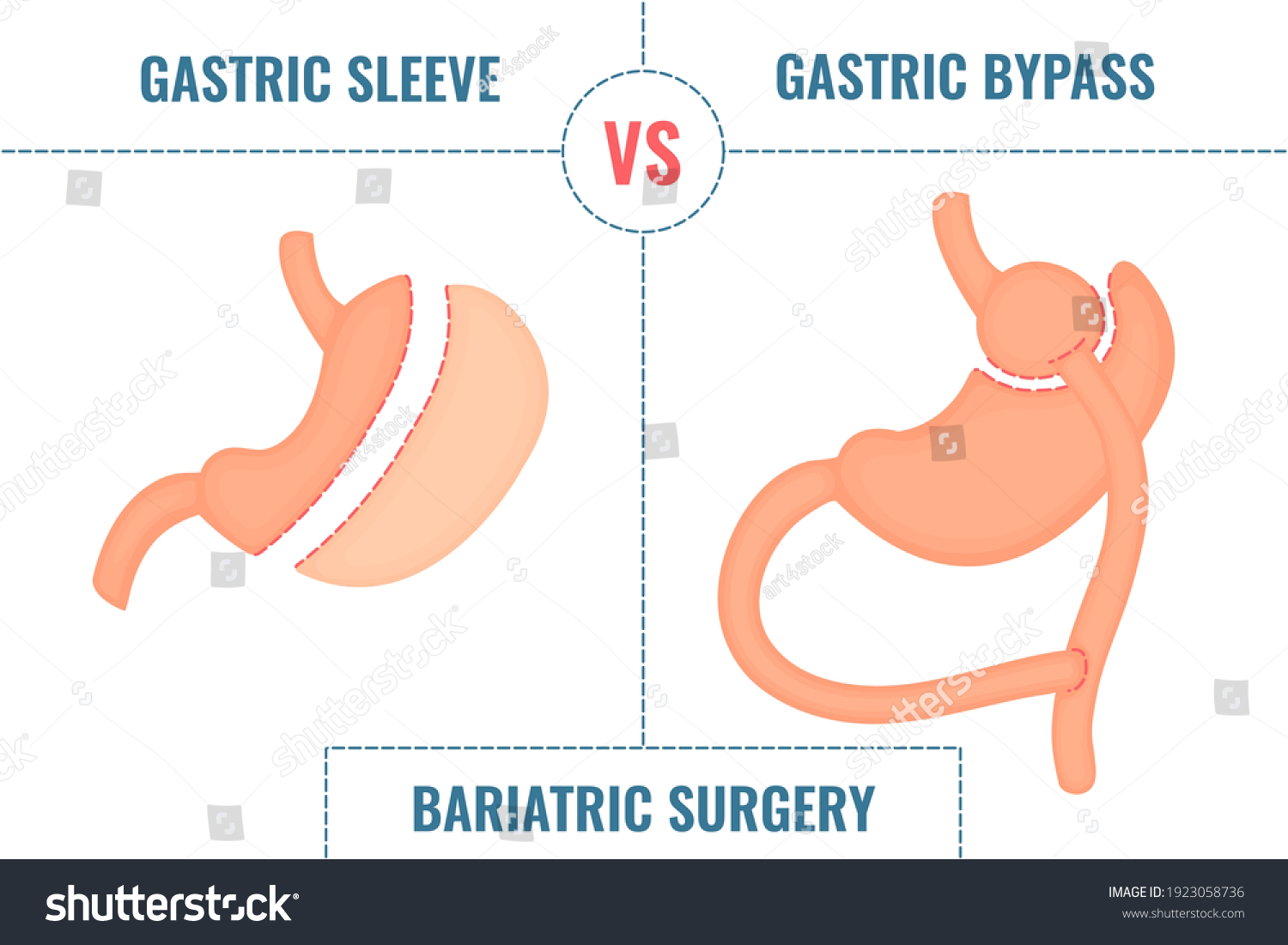 Gastric sleeve vs gastric bypass. Bariatric - Royalty Free Stock Vector ...