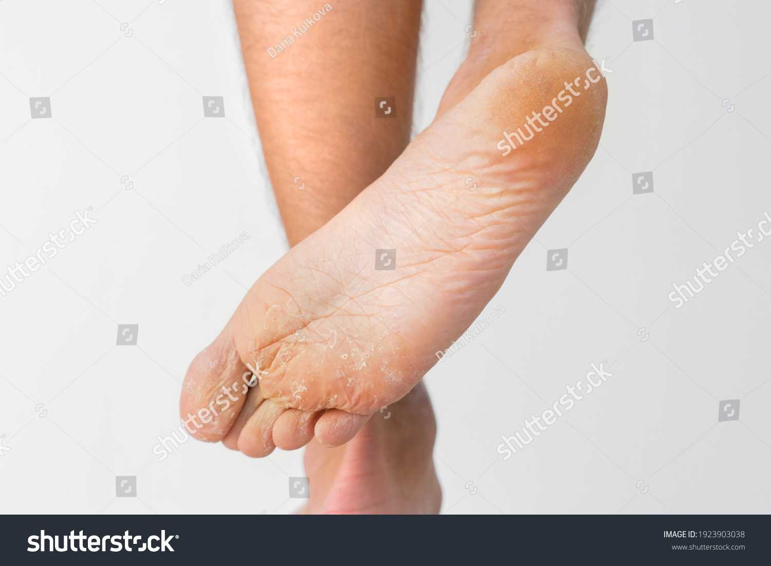 Close up of dry feet. Peeling and cracked foot. Fungal infection or athlete's foot, dry skin, dermatitis, eczema, psoriasis, sweaty feet or dehydration. Health care concept #1923903038