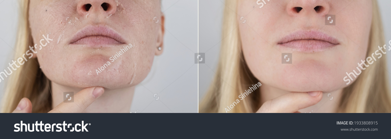 Before and after. A woman examines dry skin on her face. Peeling, coarsening, discomfort, skin sensitivity. Patient at the appointment a dermatologist or cosmetologist. Close-up of pieces of dry skin #1933808915
