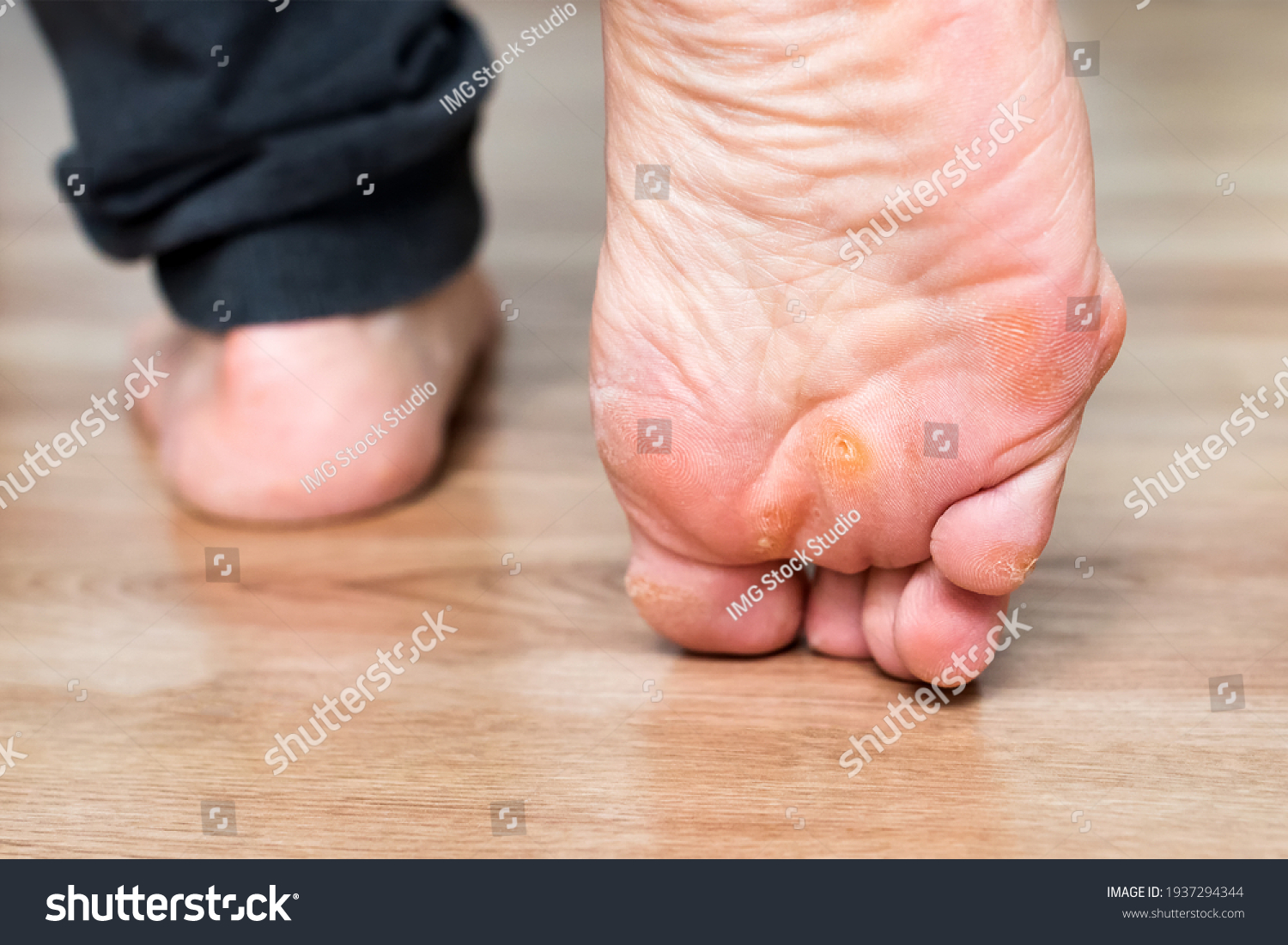 Foot with corns, calluses and dry skin, wart plantar verrucas. Verrucas papilloma callus virus, desease on foot skin. Unhealthy foot leg with corn close up. Man shows callosity before treatment. #1937294344