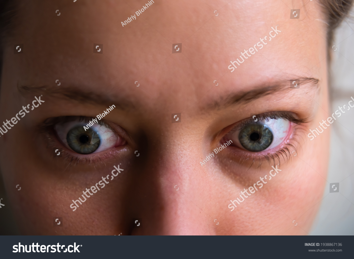 Macro closeup of young woman face with Grave's disease hyperthyroidism symptoms of ophthalmopathy bulging eyes proptosis edema #1938867136