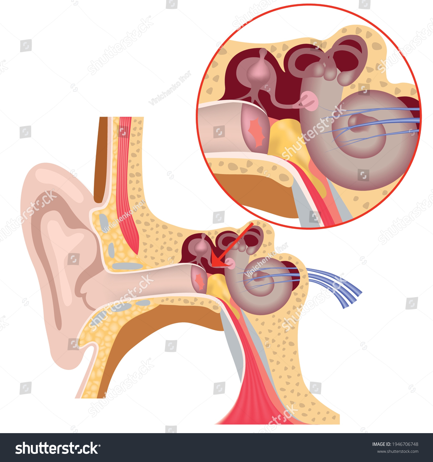 Inner Ear Anatomy. Damage To The Tympanic - Royalty Free Stock Vector 