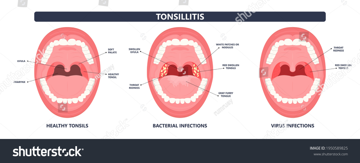 Tonsil Stones crypts viral virus gland strep - Royalty Free Stock ...