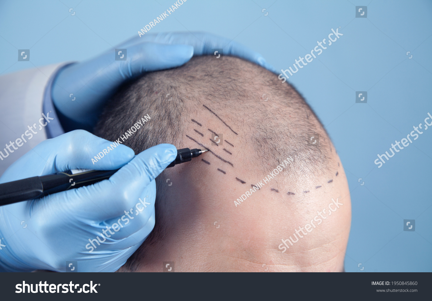Patient suffering from hair loss in consultation with a doctor. Doctor using skin marker #1950845860